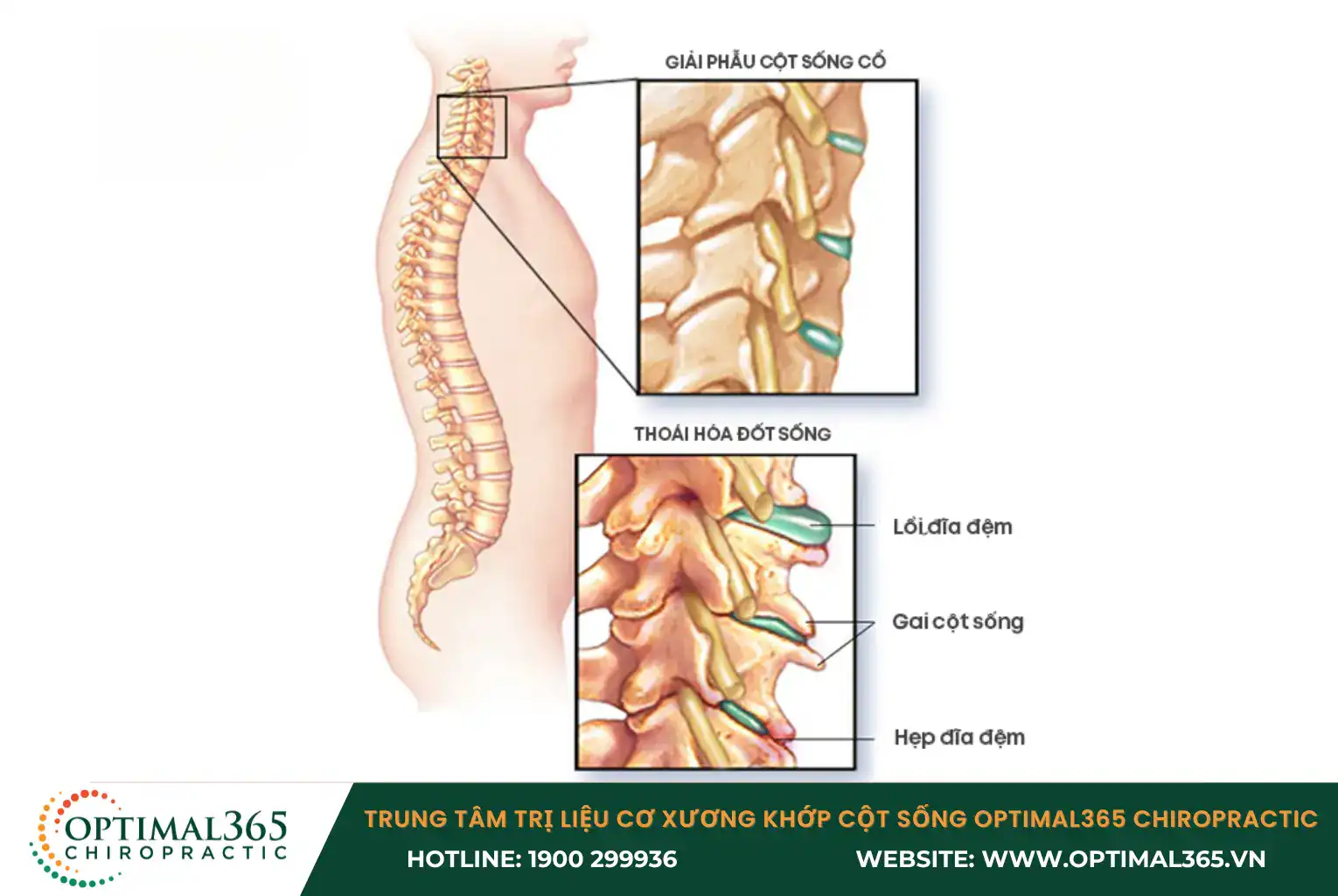 Gai xương gây cứng cổ, tê bì tay chân đặc biệt khi thực hiện các động tác xoay cổ hoặc cúi đầu