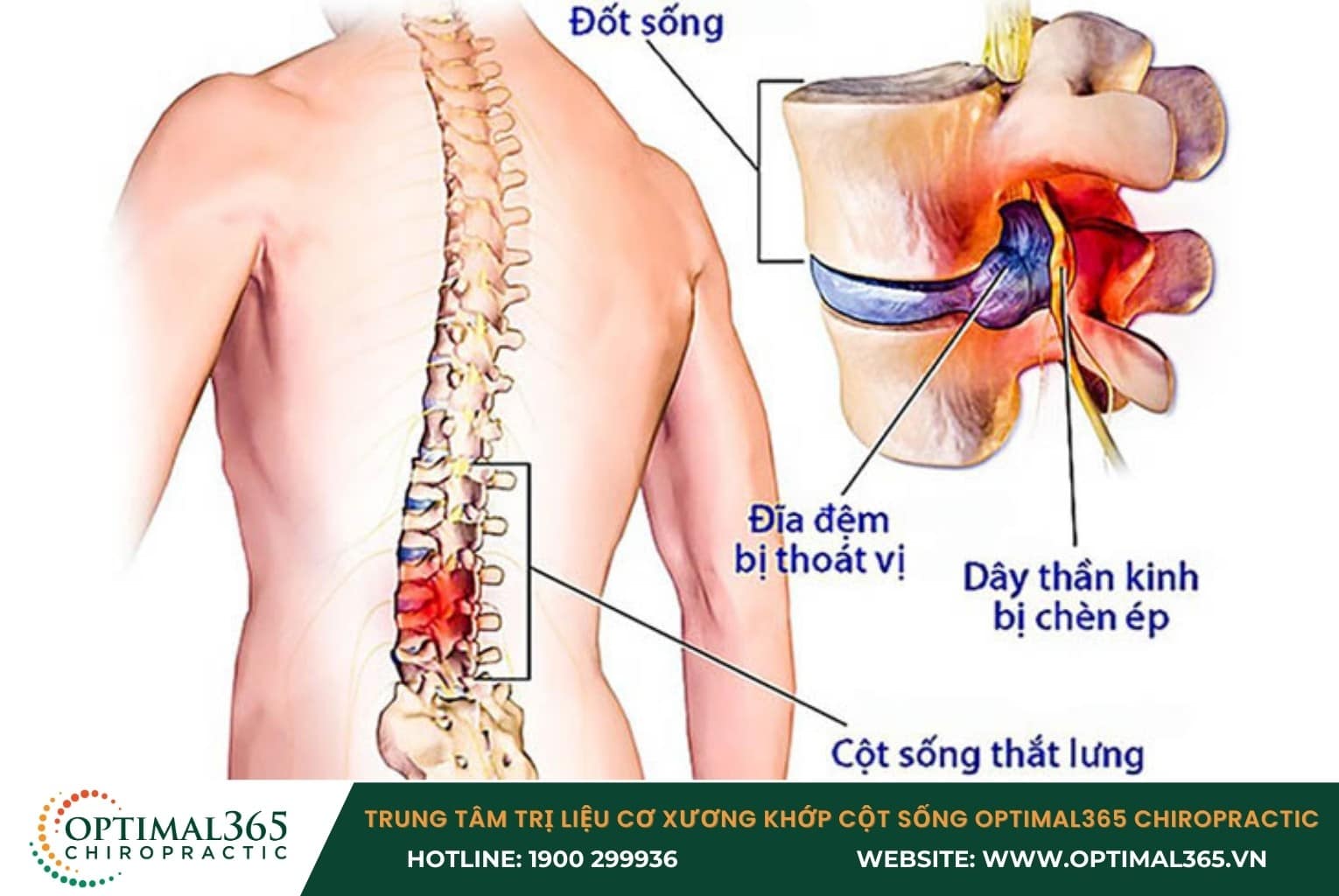 Bệnh thoát vị đĩa đệm có gây nguy hiểm không?