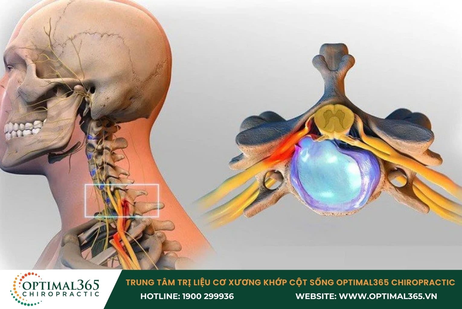Vị trí thoát vị đĩa đệm