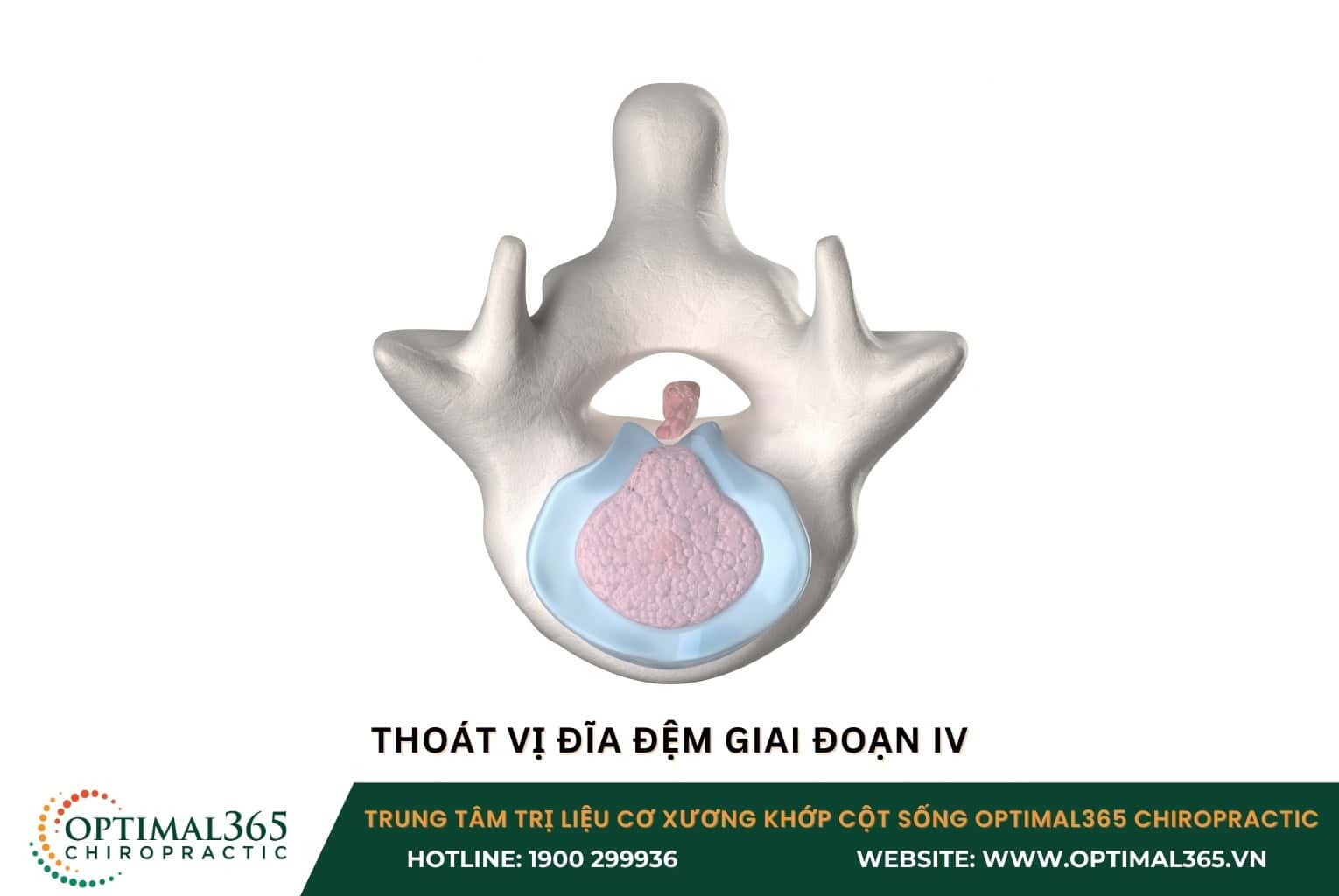 Các giai đoạn của thoát vị đĩa đệm