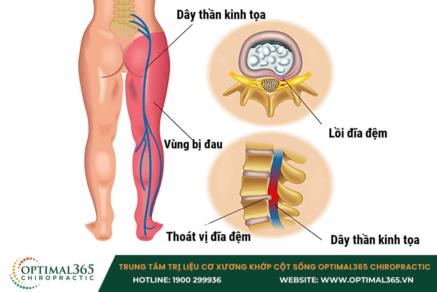 Các biến chứng nguy hiểm do thoát vị đĩa đệm cột sống thắt lưng L4 L5
