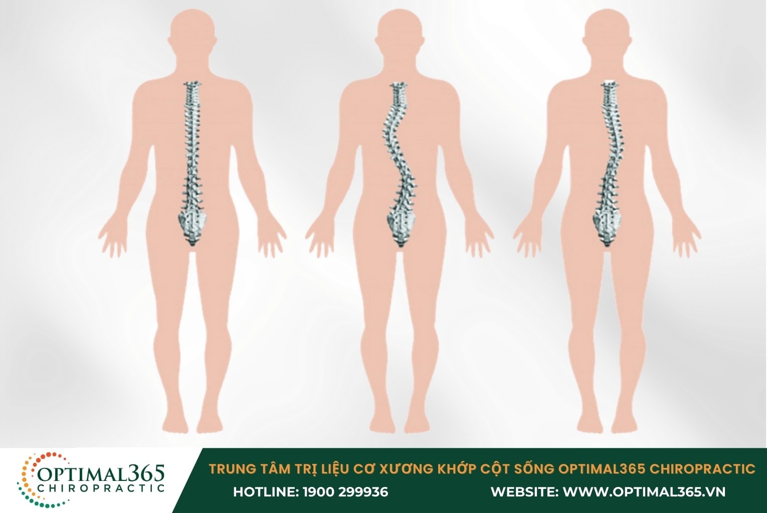 Tổng quan về cong vẹo cột sống