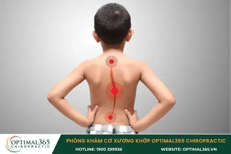 Vẹo cột sống là tình trạng rất phổ biến ở trẻ em dưới 15 tuổi