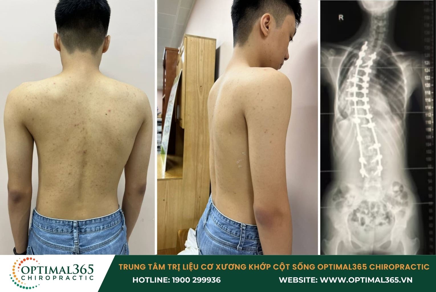 Điều trị ngoại khoa - Phẫu thuật cột sống cho trẻ có góc vẹo trên 40 độ