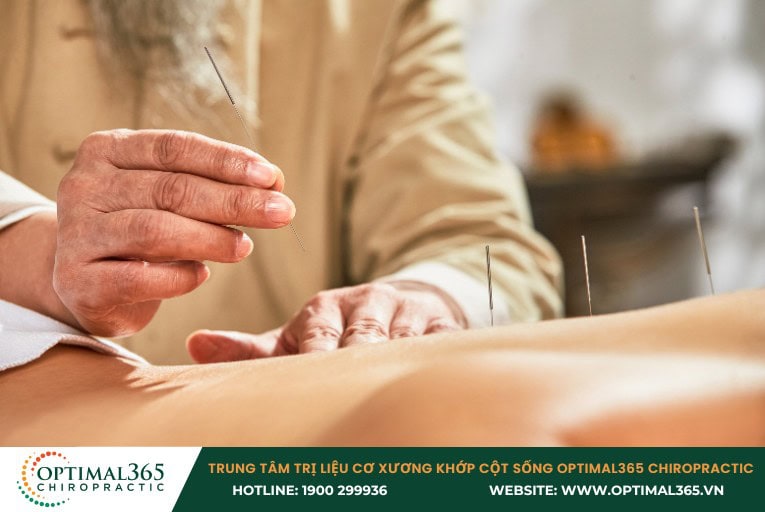 Phương pháp châm cứu chữa thoát vị đĩa đệm