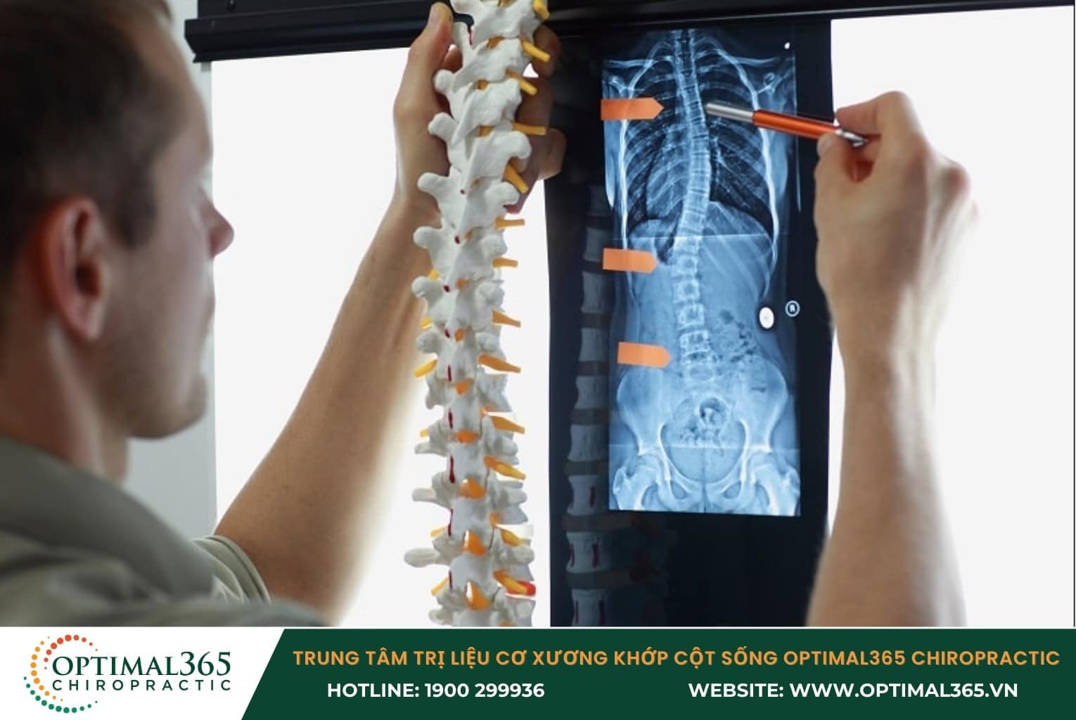 Cập nhật chi phí chữa cong vẹo cột sống hiện nay