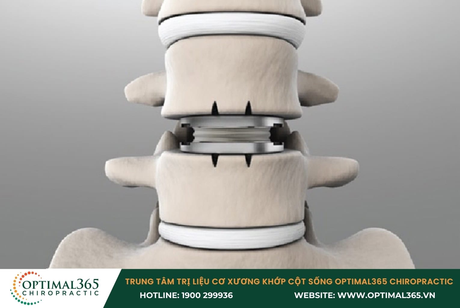 Chữa thoát vị đĩa đệm bằng cách thay đĩa đệm nhân tạo