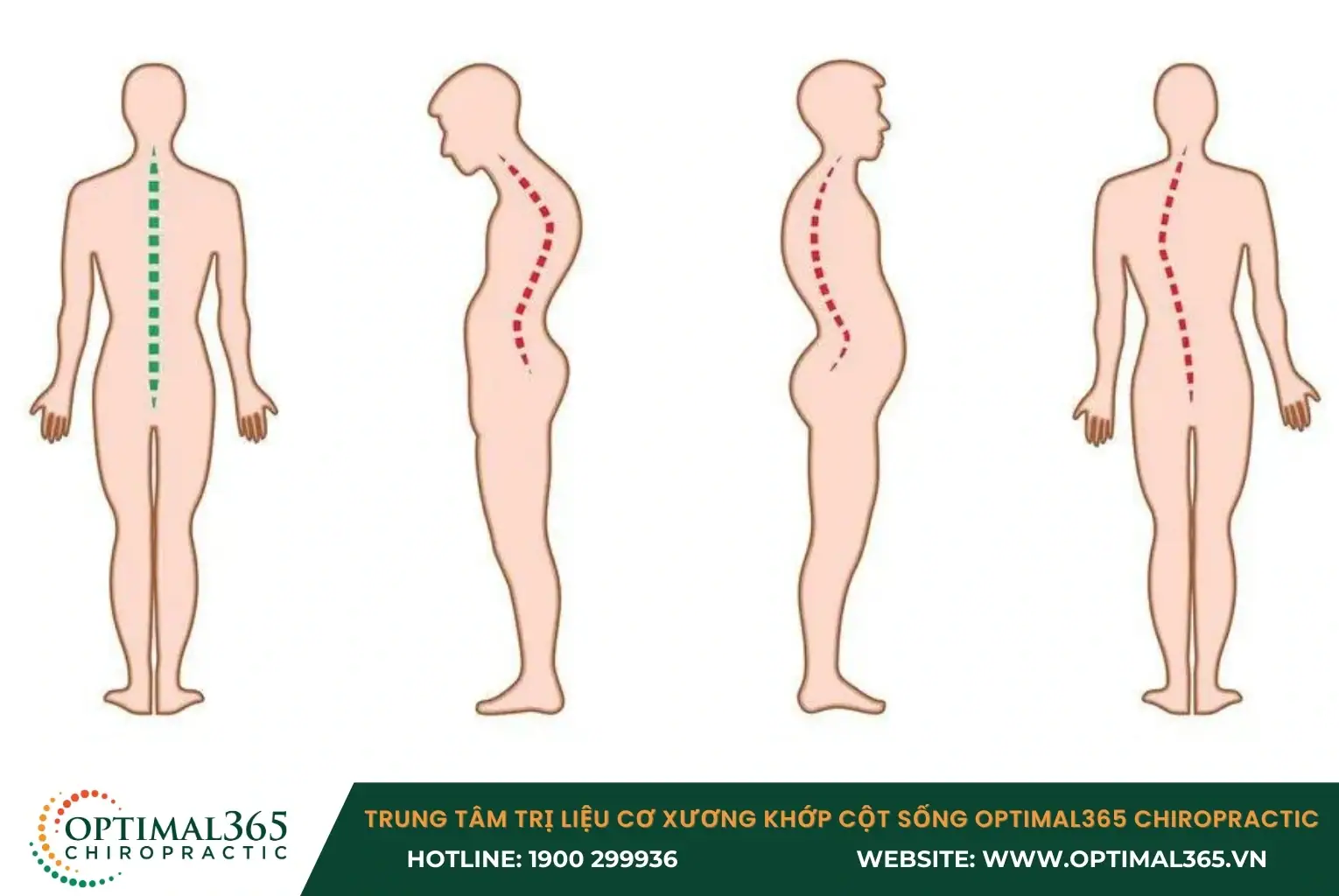 Bệnh cong vẹo cột sống là gì?