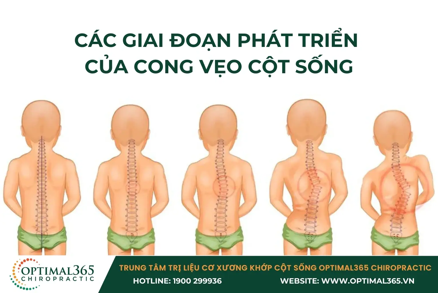 Các giai đoạn phát triển của cong vẹo cột sống