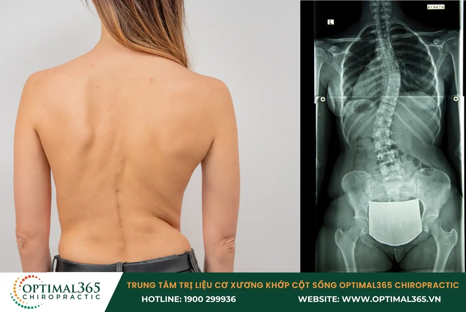 Cong vẹo cột sống chữ S