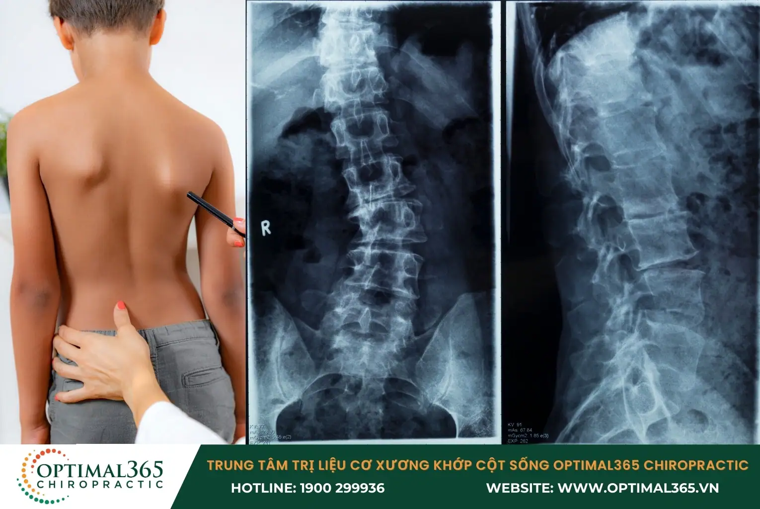 Nguyên nhân gây cong vẹo cột sống