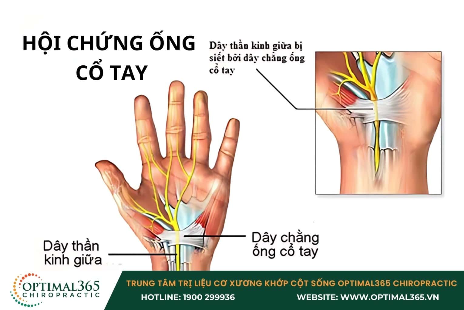 Những nguyên nhân khiến cổ tay bị đau