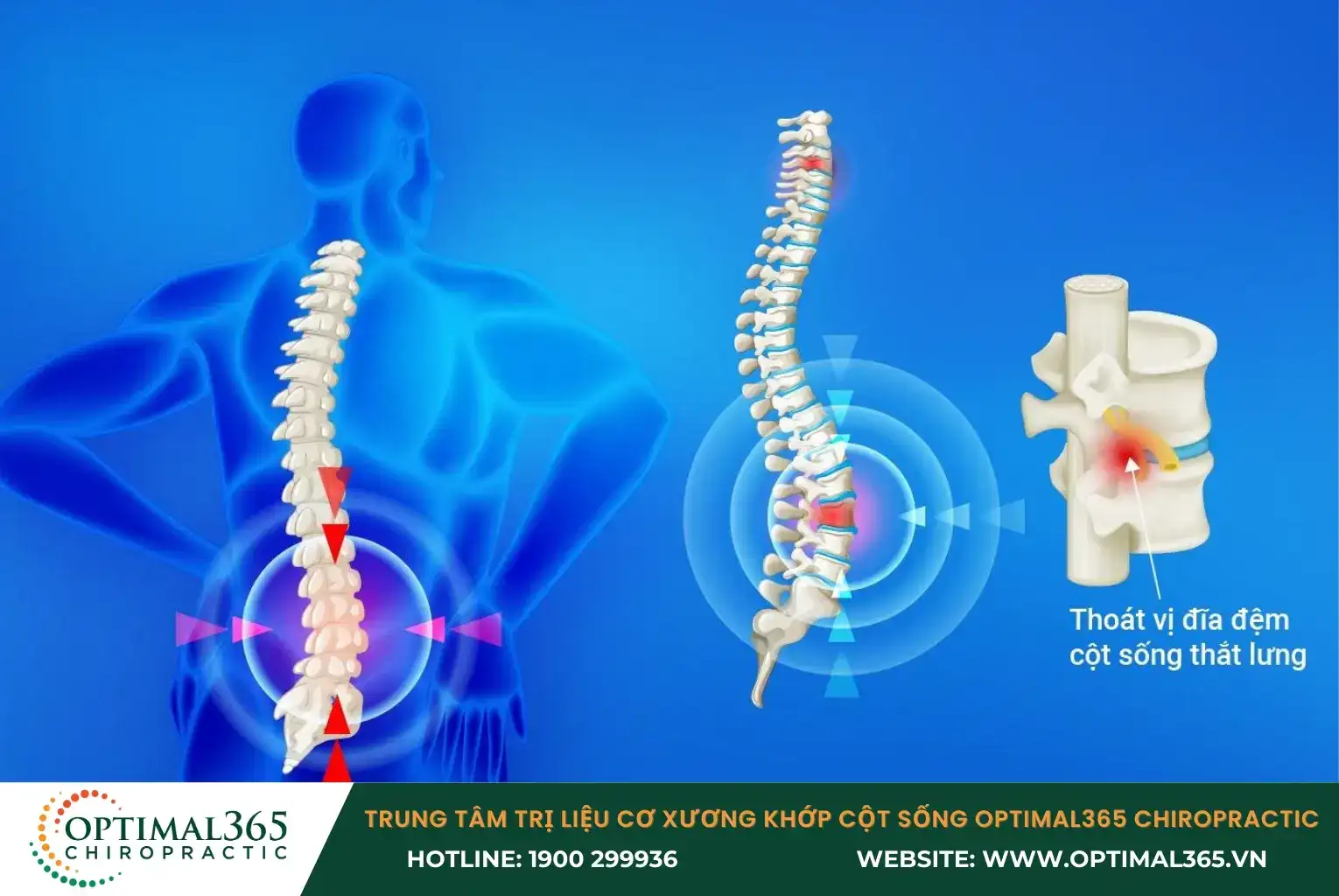 Nhiều người bị đau cột sống chủ yếu do thoát vị đĩa đệm