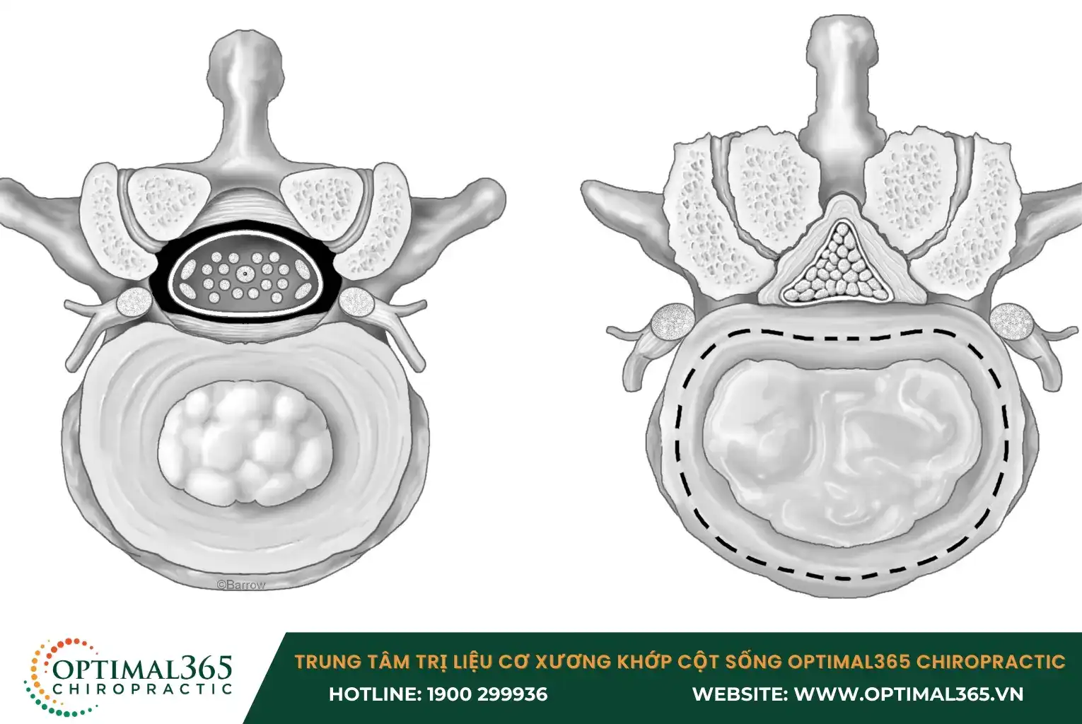 Phần ống sống bị hẹp rõ rệt cho áp lực chèn ép