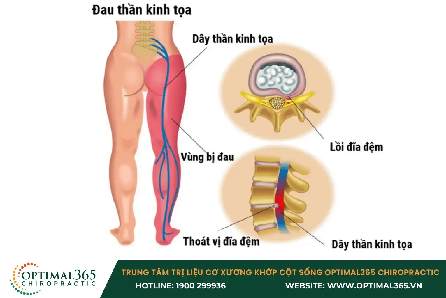 Đau thần kinh tọa lây lan khắp chân vô cùng khó chịu