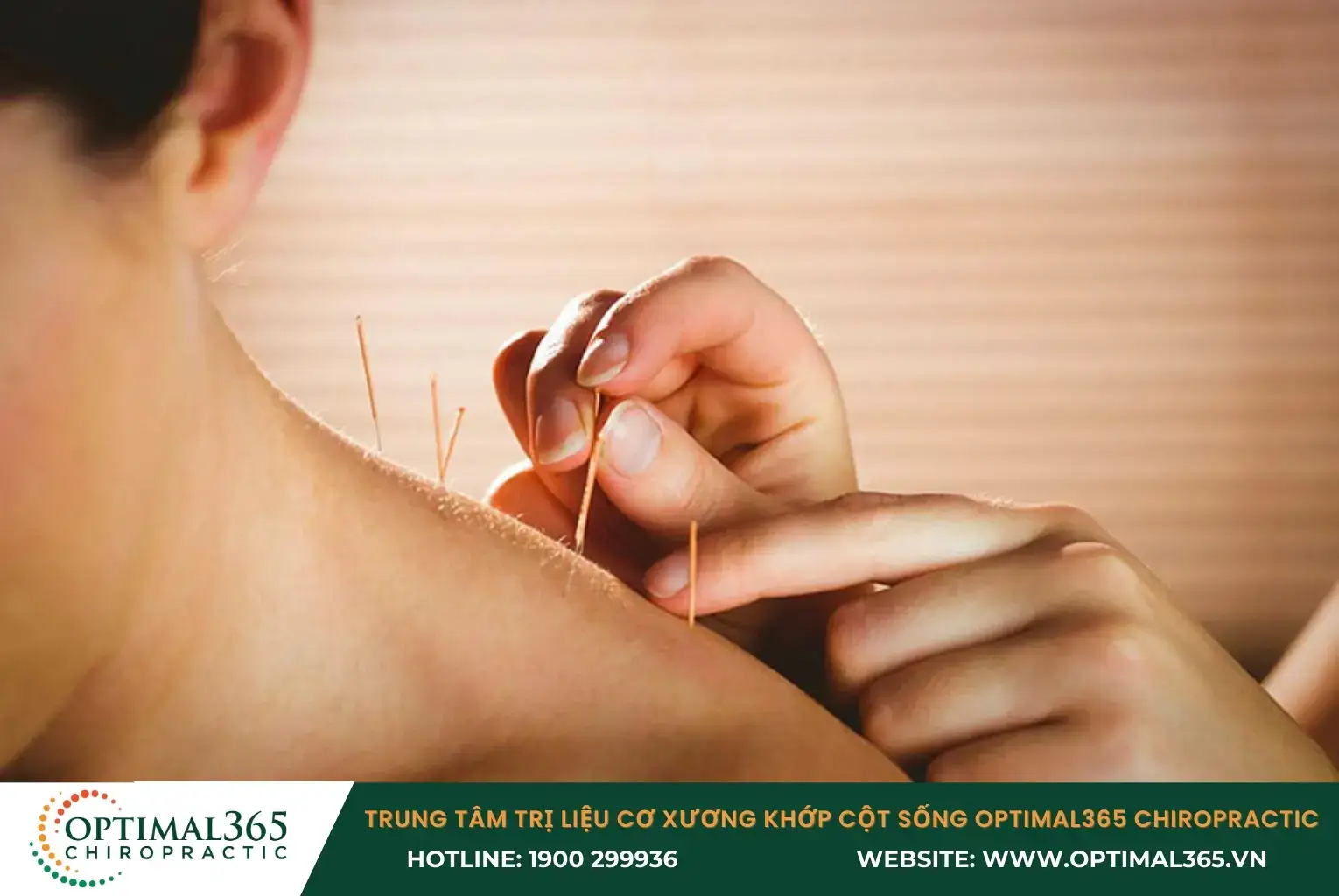 Châm cứu là một phương pháp y học cổ truyền được sử dụng rộng rãi trong việc điều trị thoái hóa cột sống