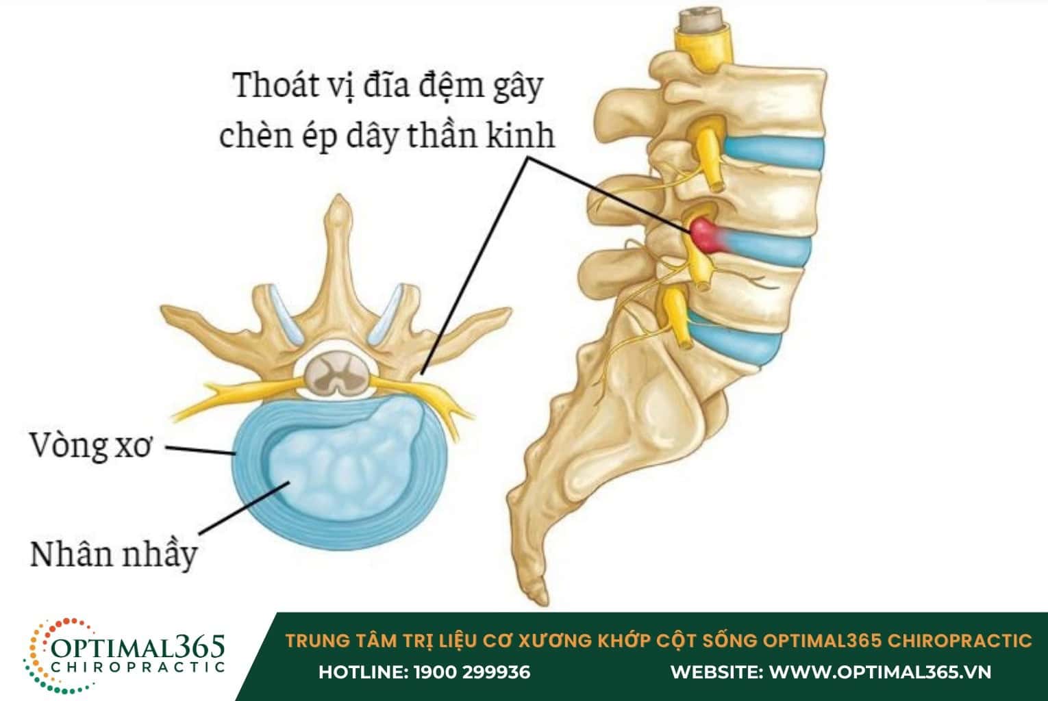 Thoát vị đĩa đệm là bệnh gì?