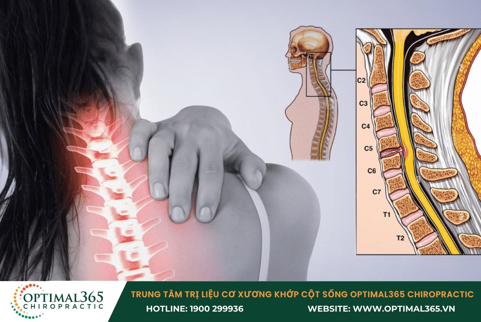 Cấu tạo đốt sống cổ, thoát vị đĩa đệm cột sống cổ là gì?