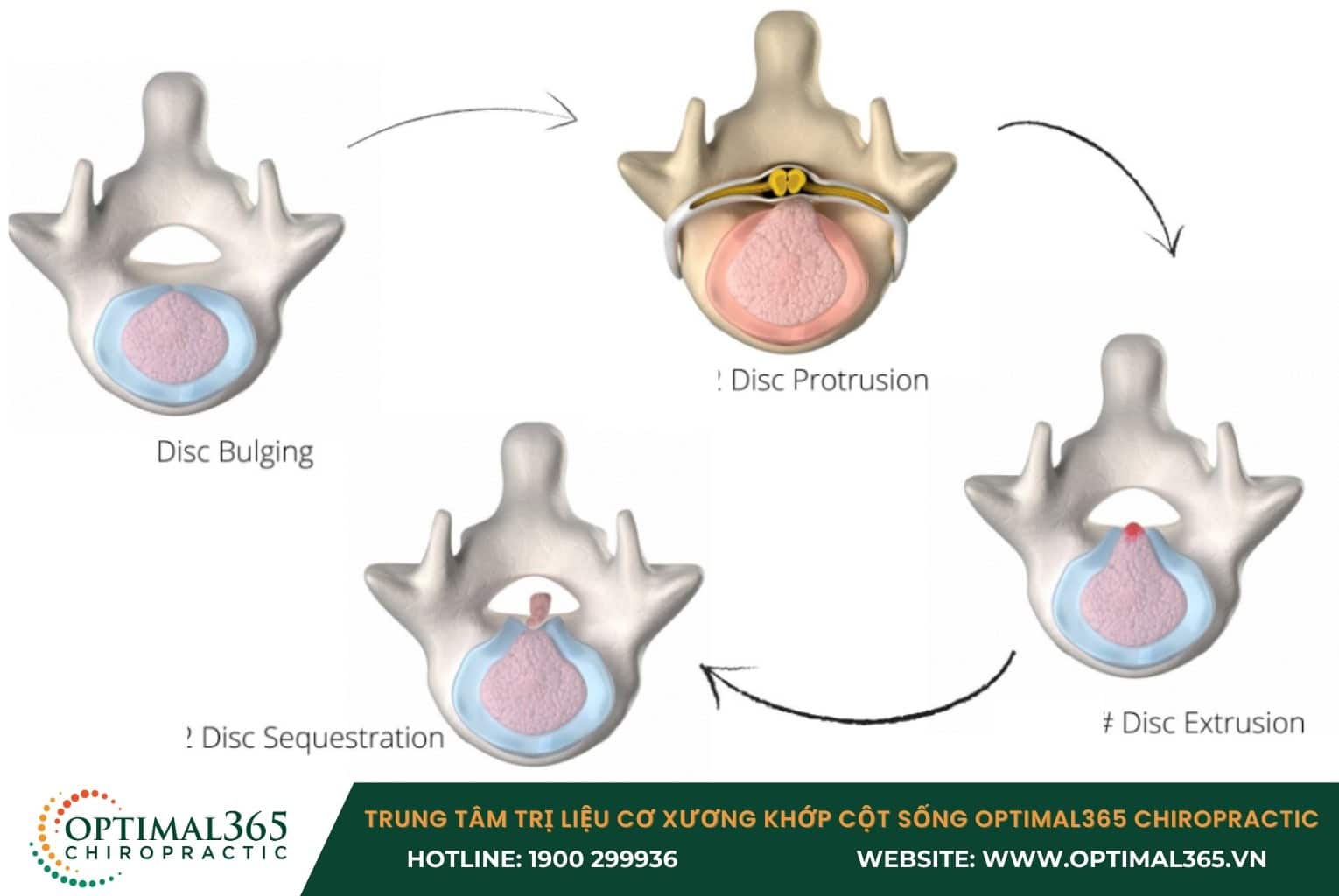 Các giai đoạn phát triển của bệnh thoát vị đĩa đệm cột sống thắt lưng