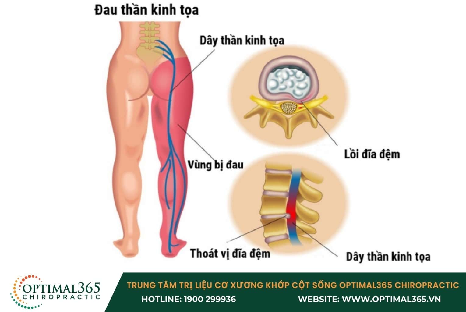 Những triệu chứng thường gặp khi bị thoát vị đĩa đệm L4 L5