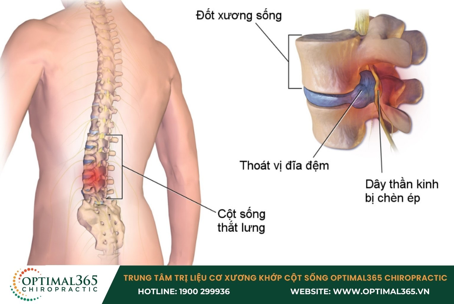 Thoát vị đĩa đệm cột sống thắt lưng L4 L5 là gì?