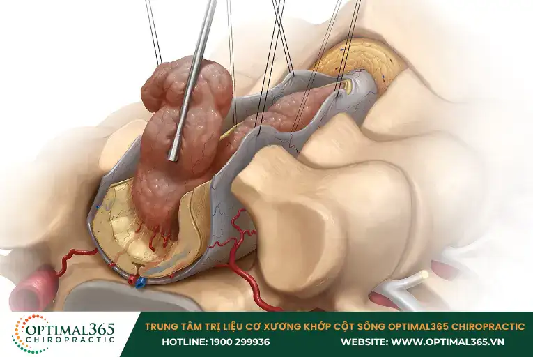 Đau lưng ở trẻ em nguyên nhân do u tủy và xương sống