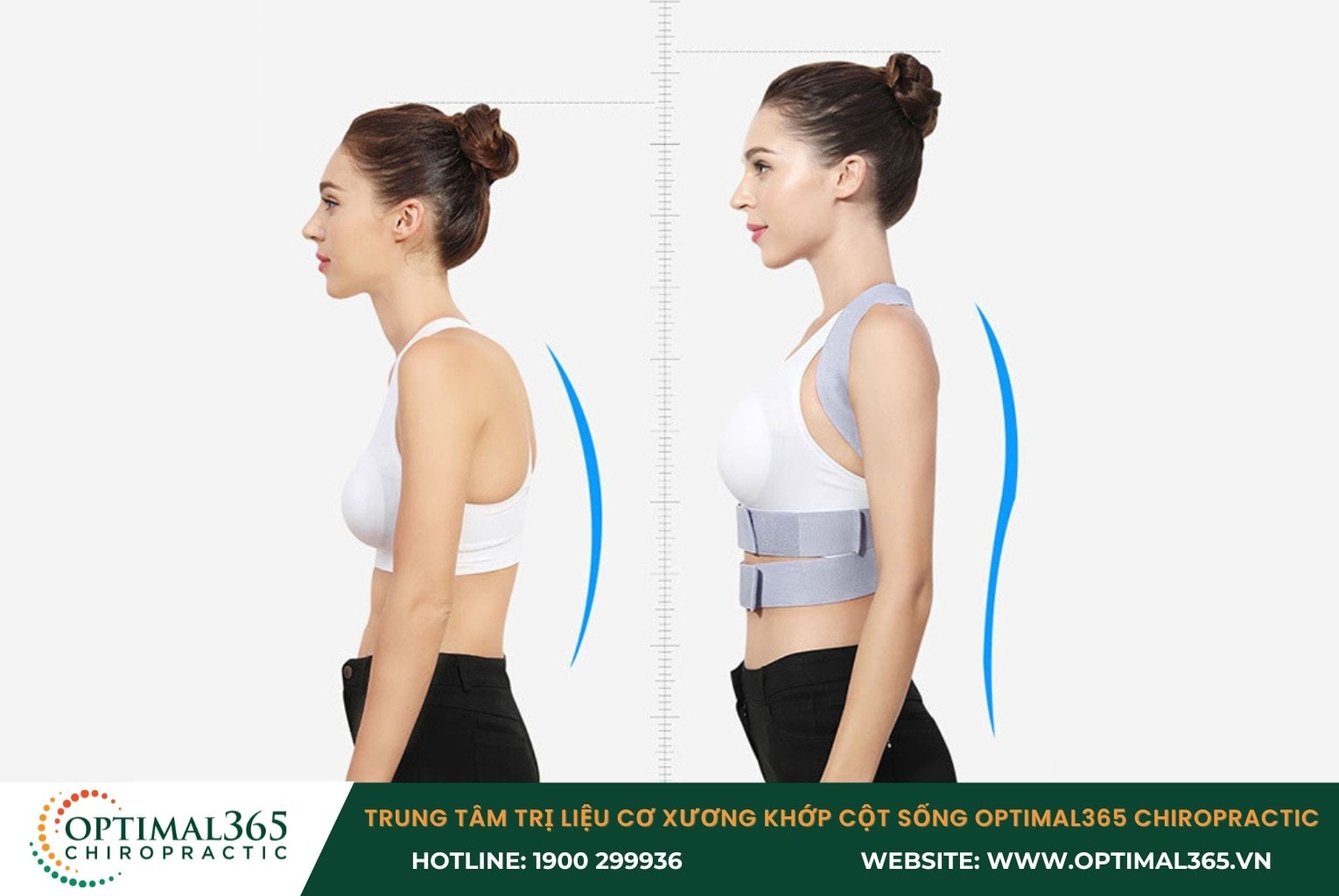 Đeo đai điều chỉnh vẹo cột sống