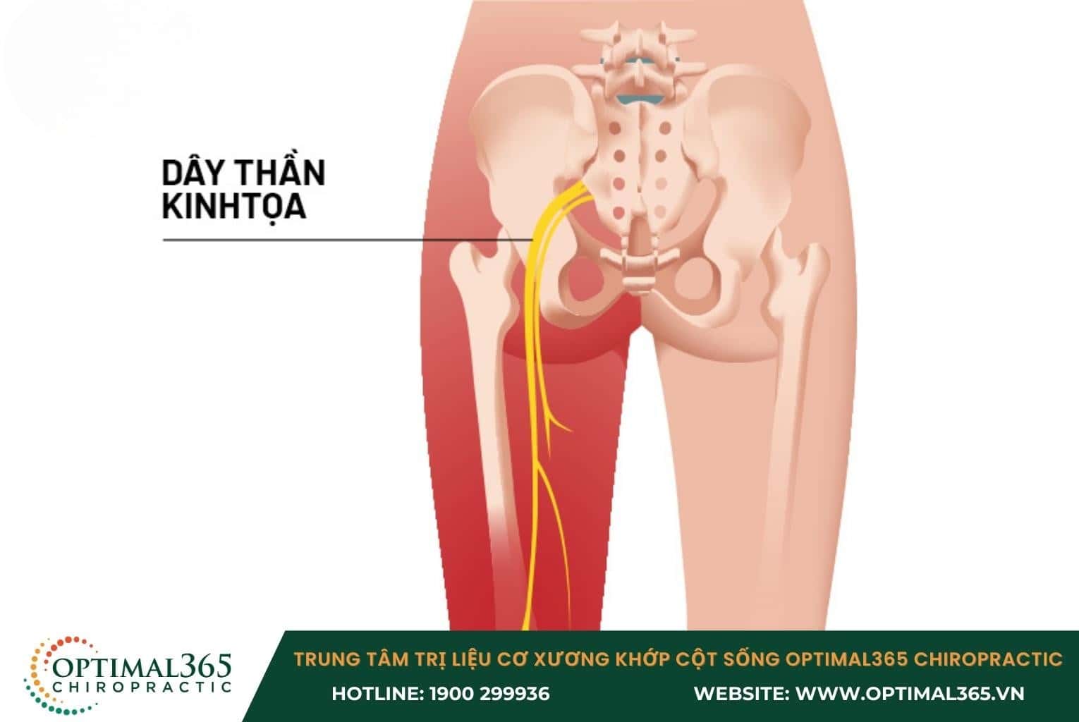 Triệu chứng của thoái hóa đốt sống thắt lưng L4 L5