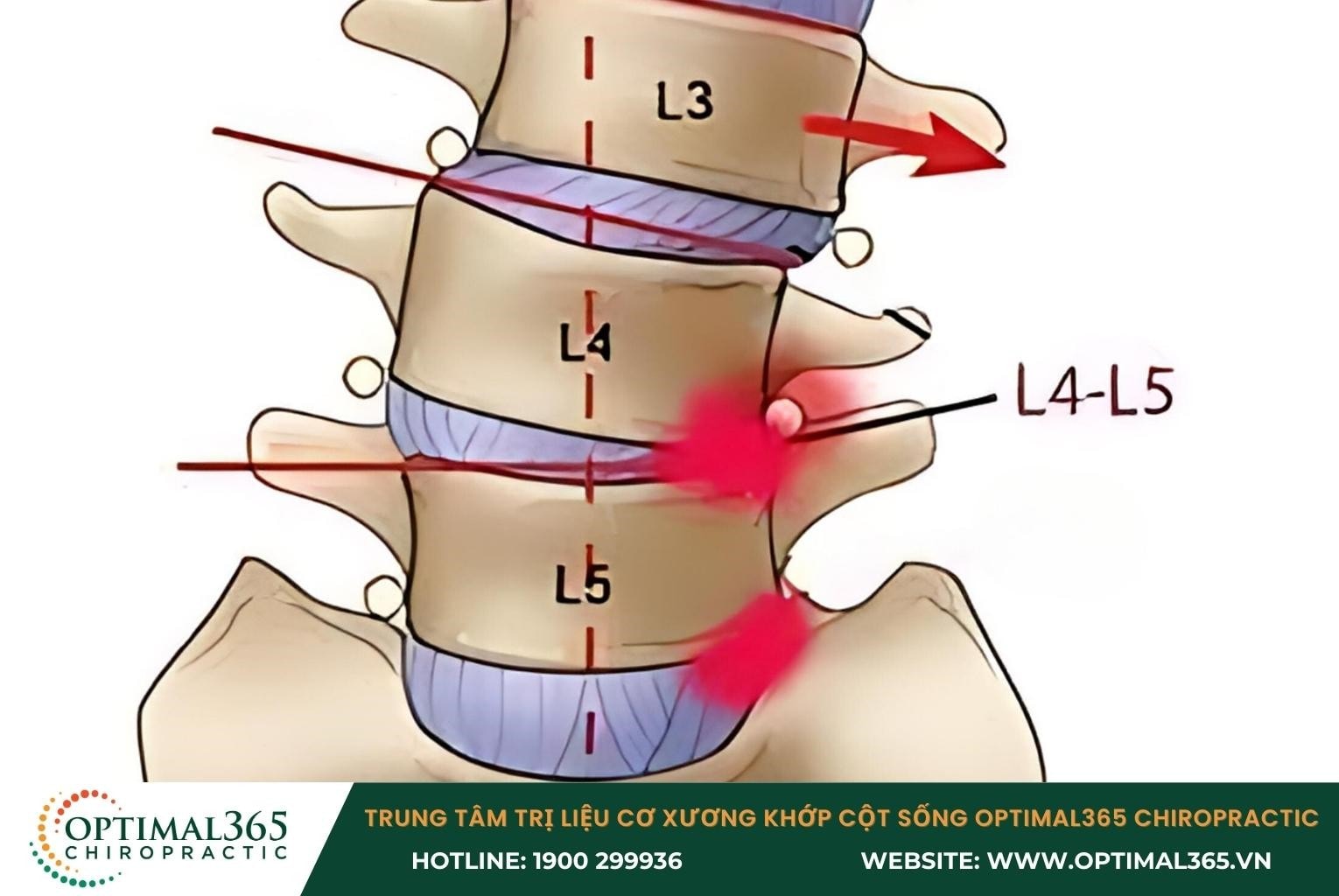 Thoái hóa đốt sống lưng L4 L5 là gì?