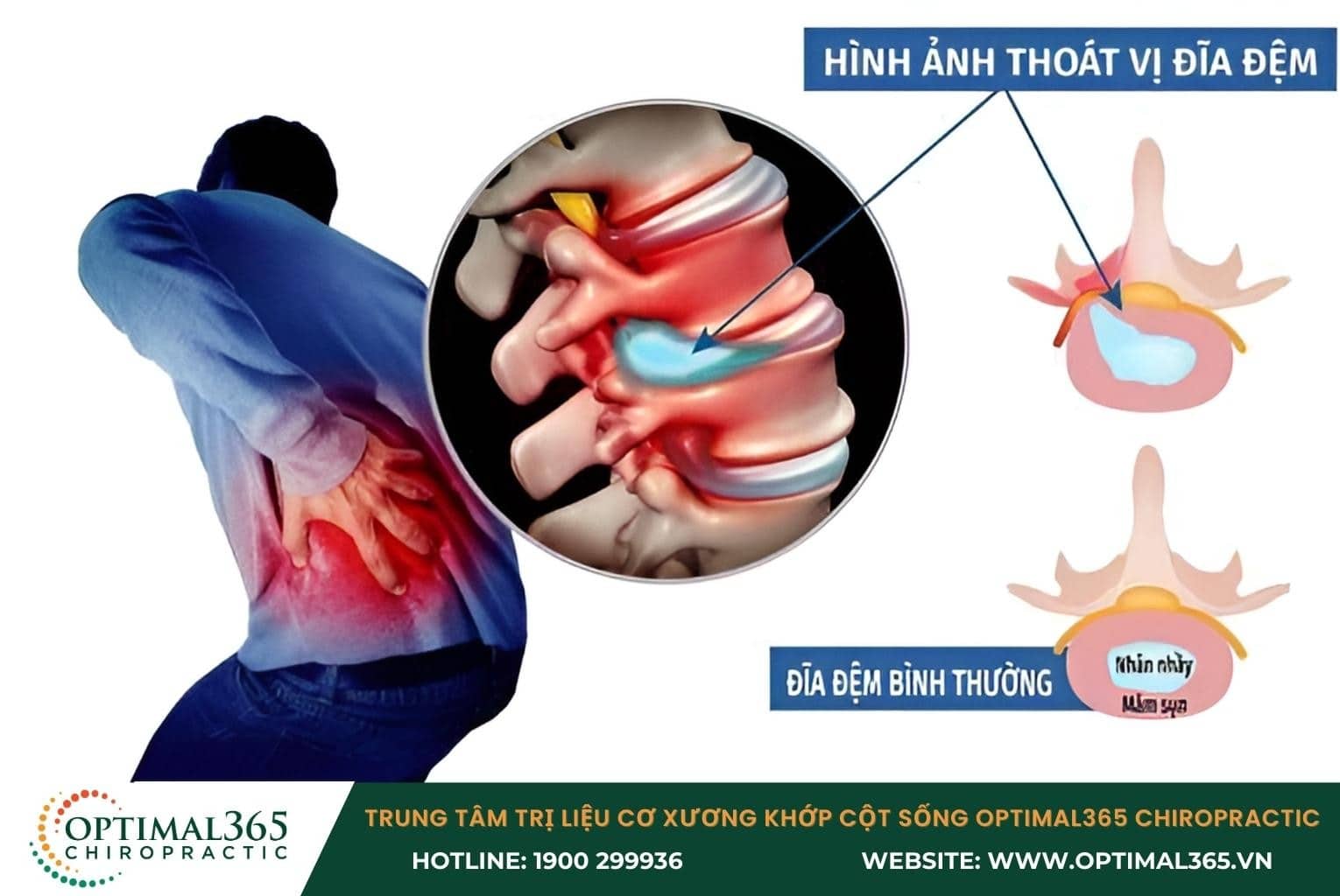 Những biến chứng do thoái hoá đốt sống thắt lưng L4 L5 gây ra