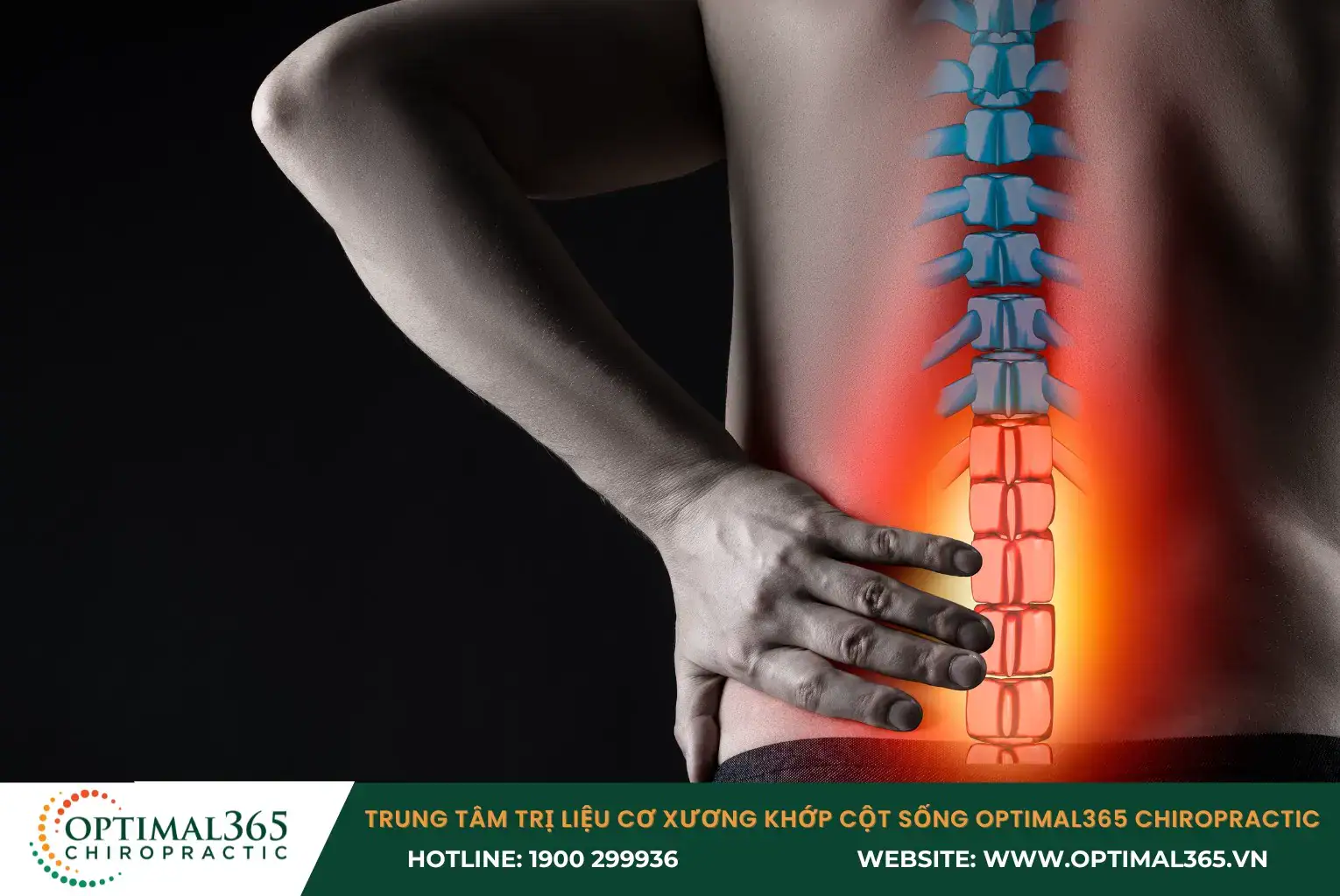 Sciatica caused by injury or irritation to the sciatic nerve 