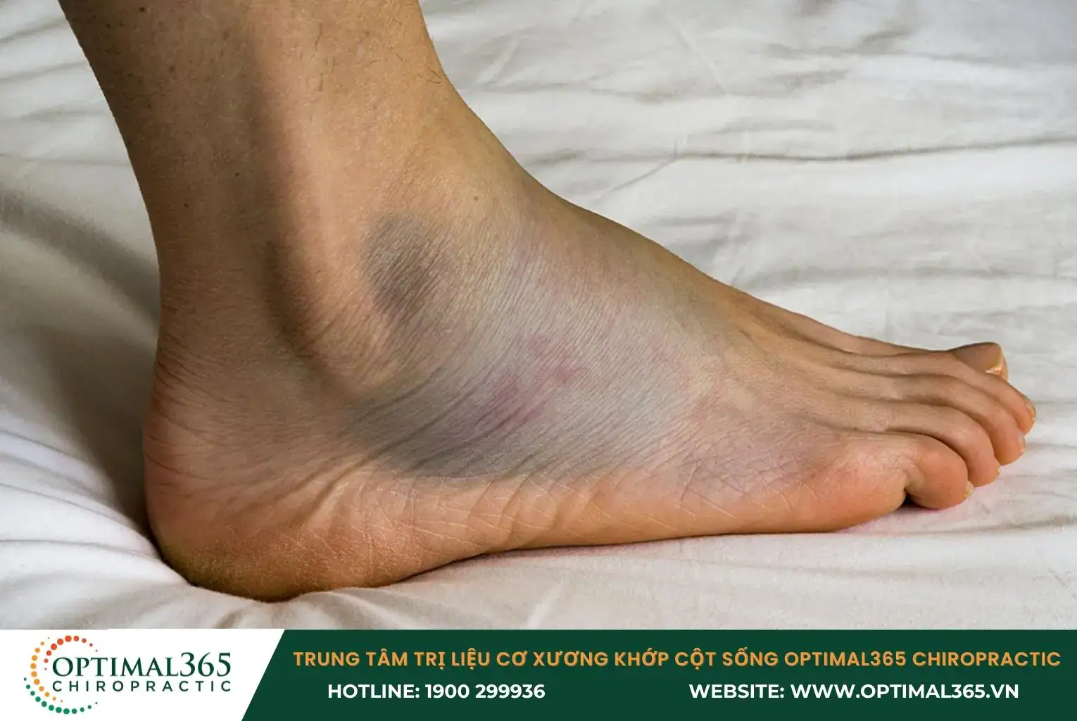 Các mạch máu nhỏ xung quanh dây chằng bị rách, gây chảy máu dưới da, tạo thành các vết thâm