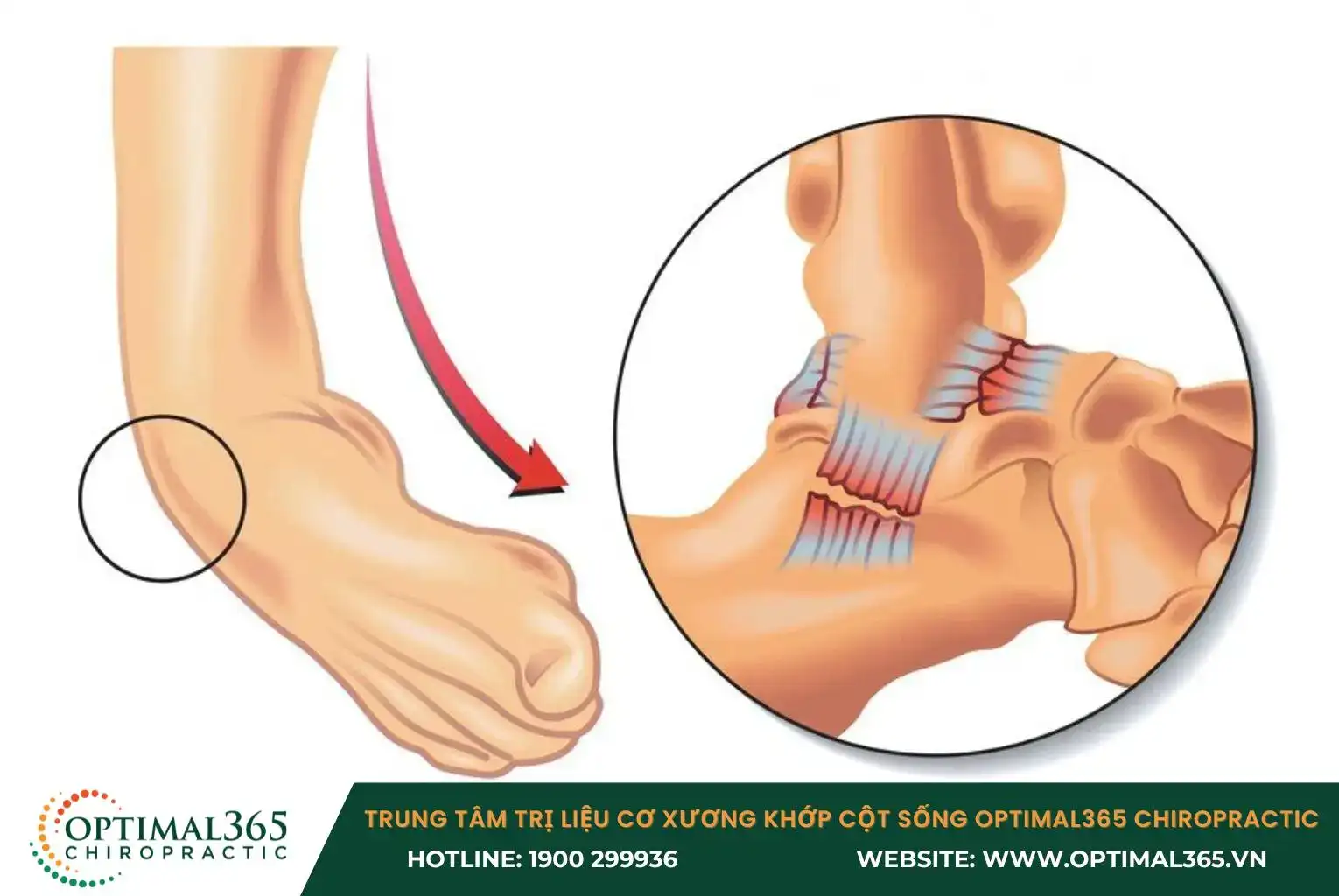Khi bàn chân bị lật ra ngoài, dây chằng deltoid sẽ bị tổn thương dẫn đến bong gân
