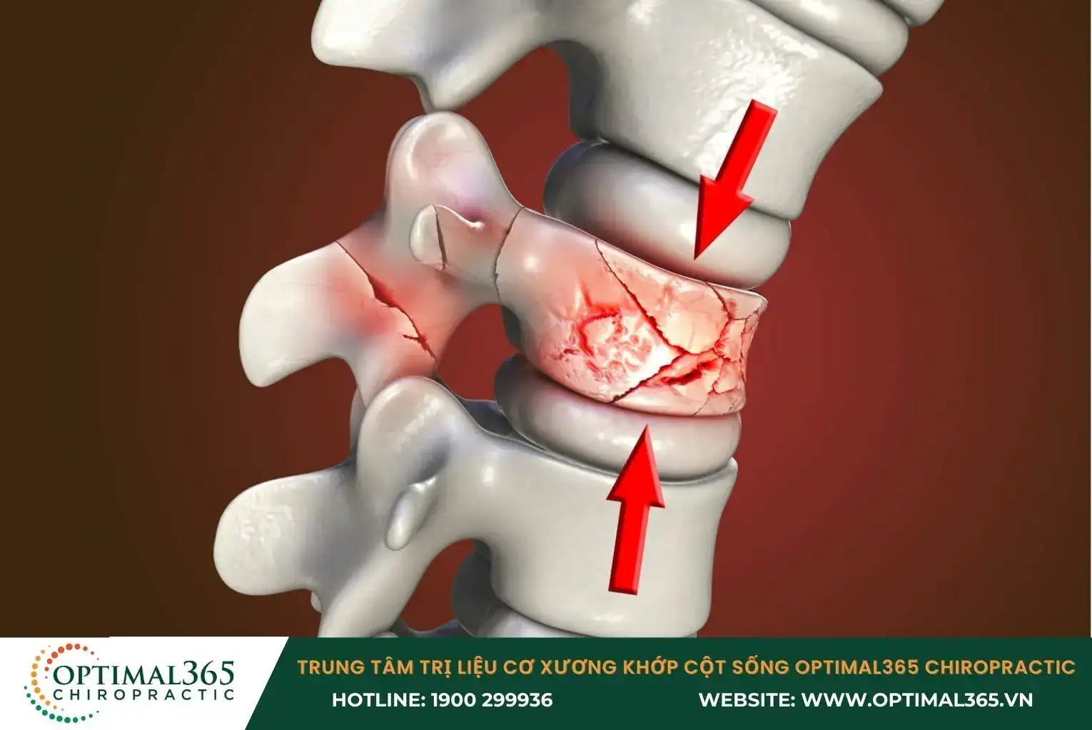 Tổn thương đốt sống