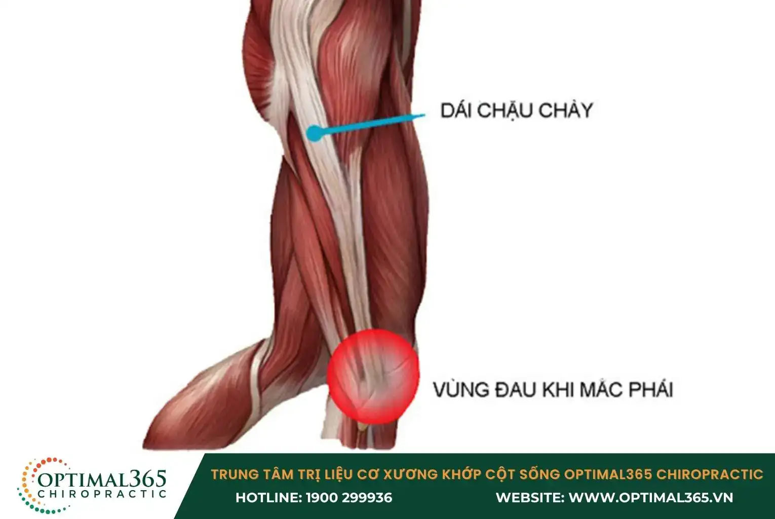 Hội chứng dải chậu chày đầu gối thường gặp ở vận động viên điền kinh