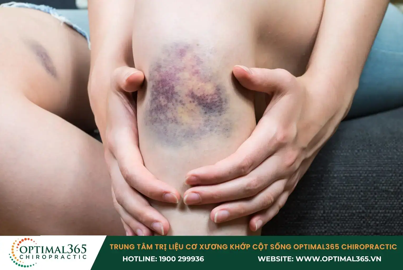 Trật khớp đầu gối có triệu chứng như sưng tấy, bầm tím đầu gối