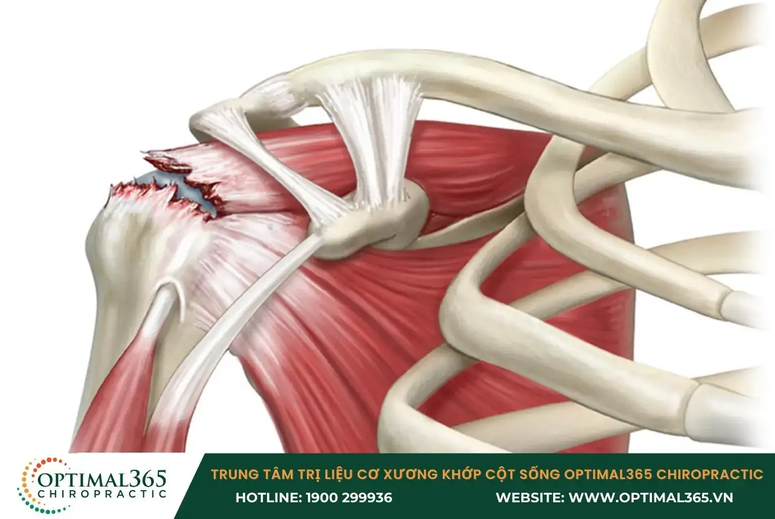 Dây chằng bị rách hoặc đứt do co giãn quá mức