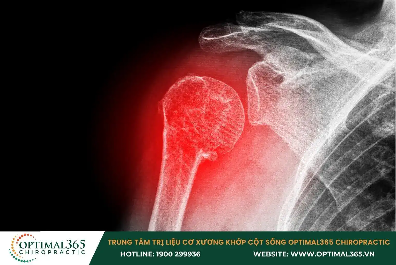 Trật khớp bả vai thường gặp khi chơi thể thao hay té ngã