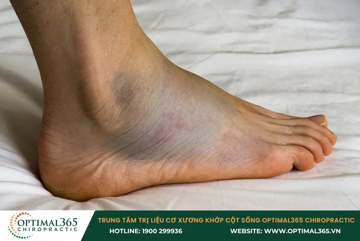 Xuất hiện các vết bầm tím trên da xung quanh cổ chân do chảy máu từ các mạch máu bị tổn thương