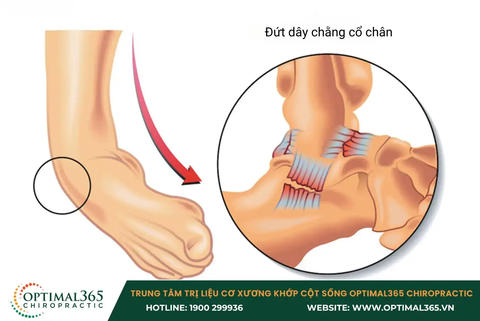 Khi dây chằng bị kéo căng quá mức, chúng có thể bị rách hoặc đứt hoàn toàn