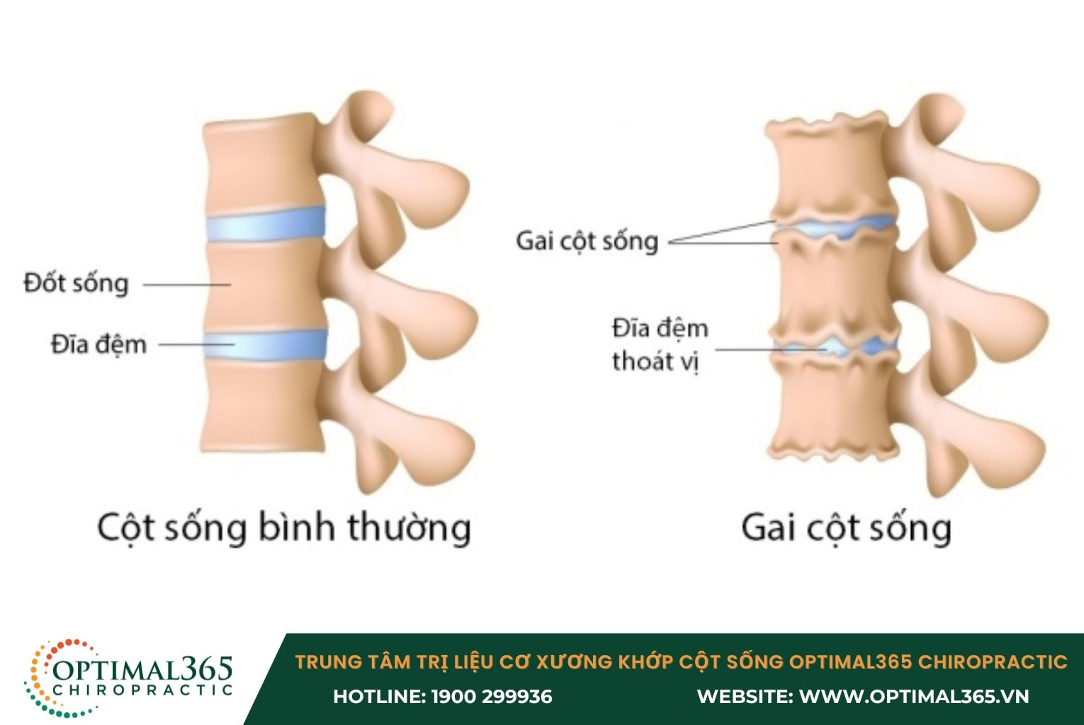 Gai cột sống thắt lưng là bệnh gì?