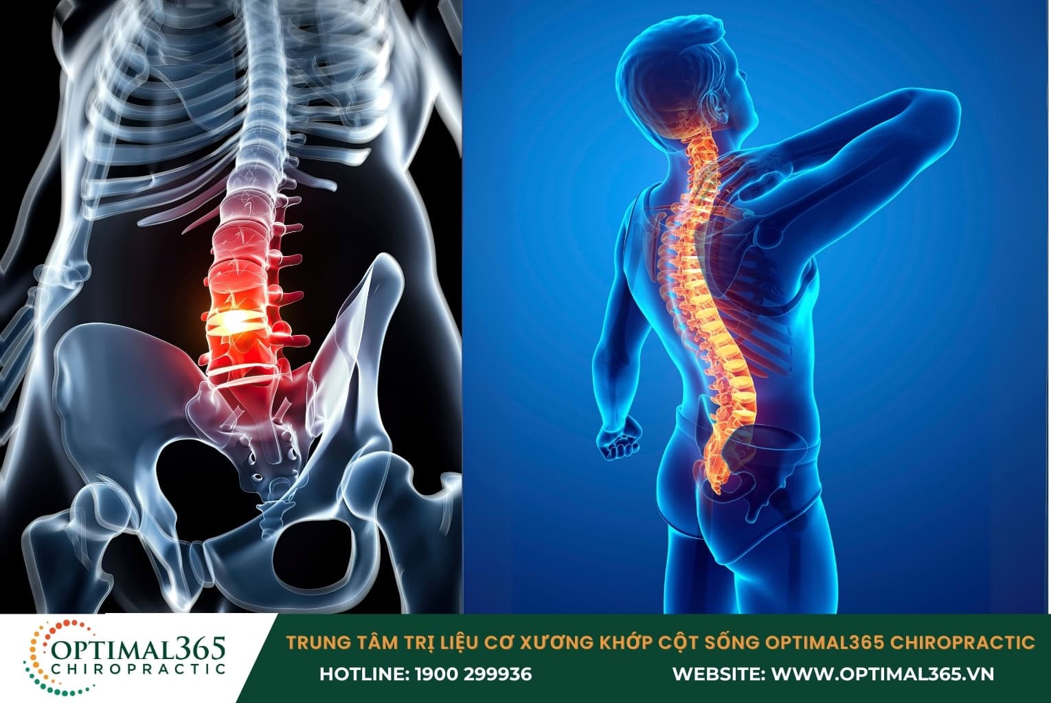 A herniated Disc is a musculoskeletal condition that is becoming increasingly common.