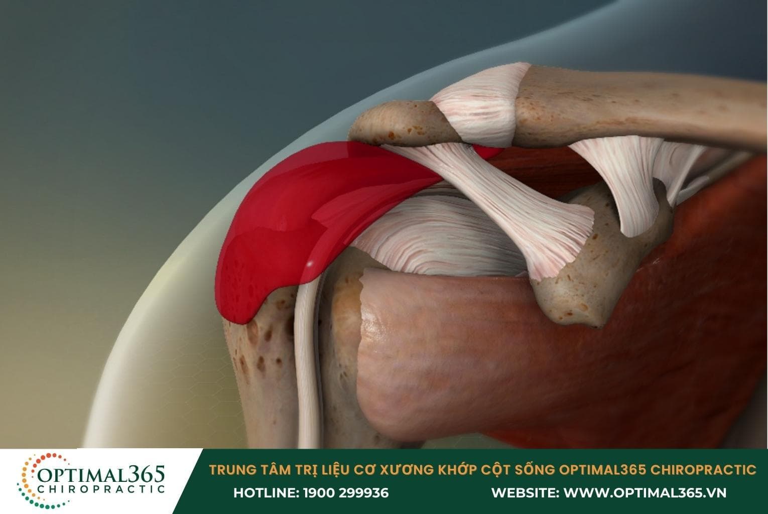 Viêm bao hoạt dịch làm giảm khả năng vận động khớp vai