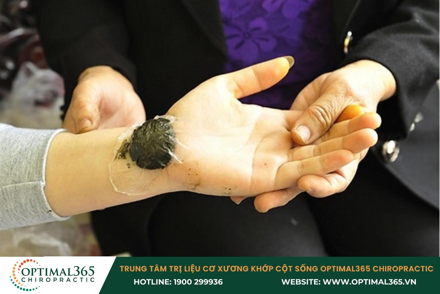 Không nên tự điều trị bong gân bằng các bài thuốc chưa kiểm chứng