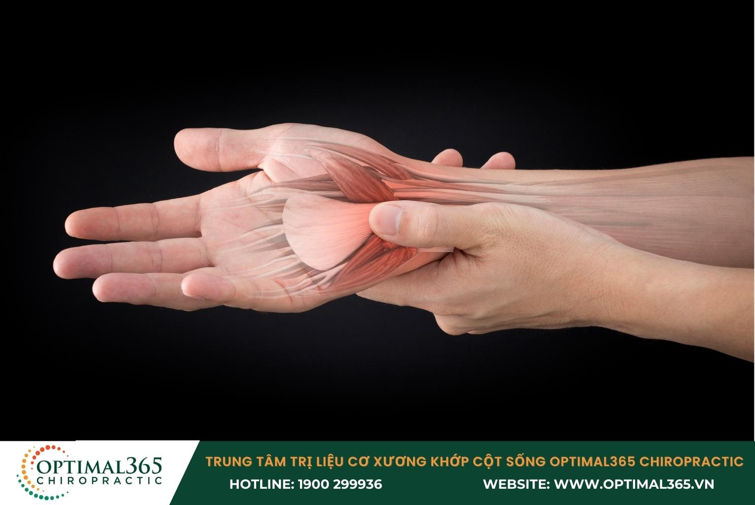 Bong gân cổ tay có 3 cấp độ từ nhẹ đến nặng