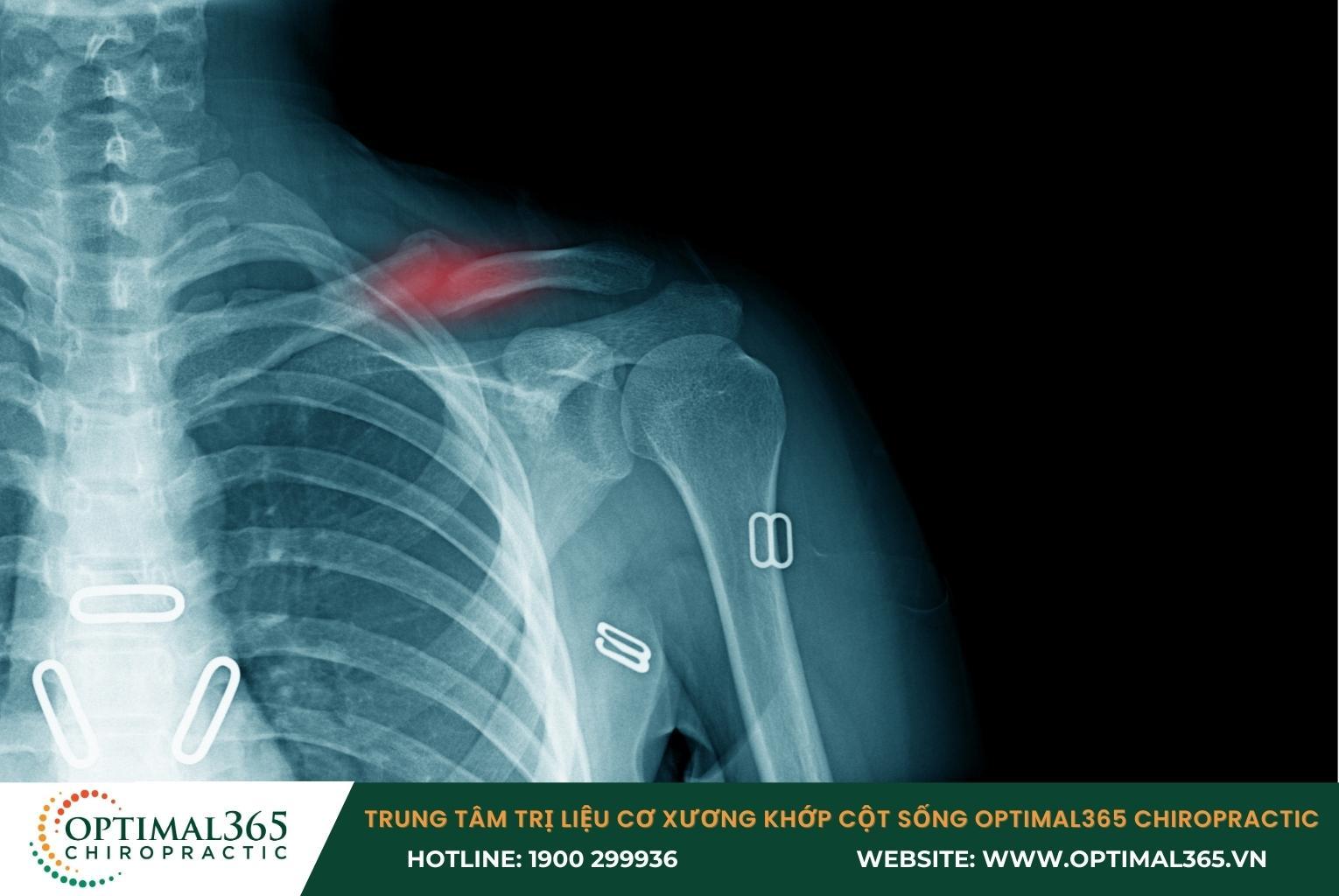 Tác động lực mạnh làm gãy xương bả vai