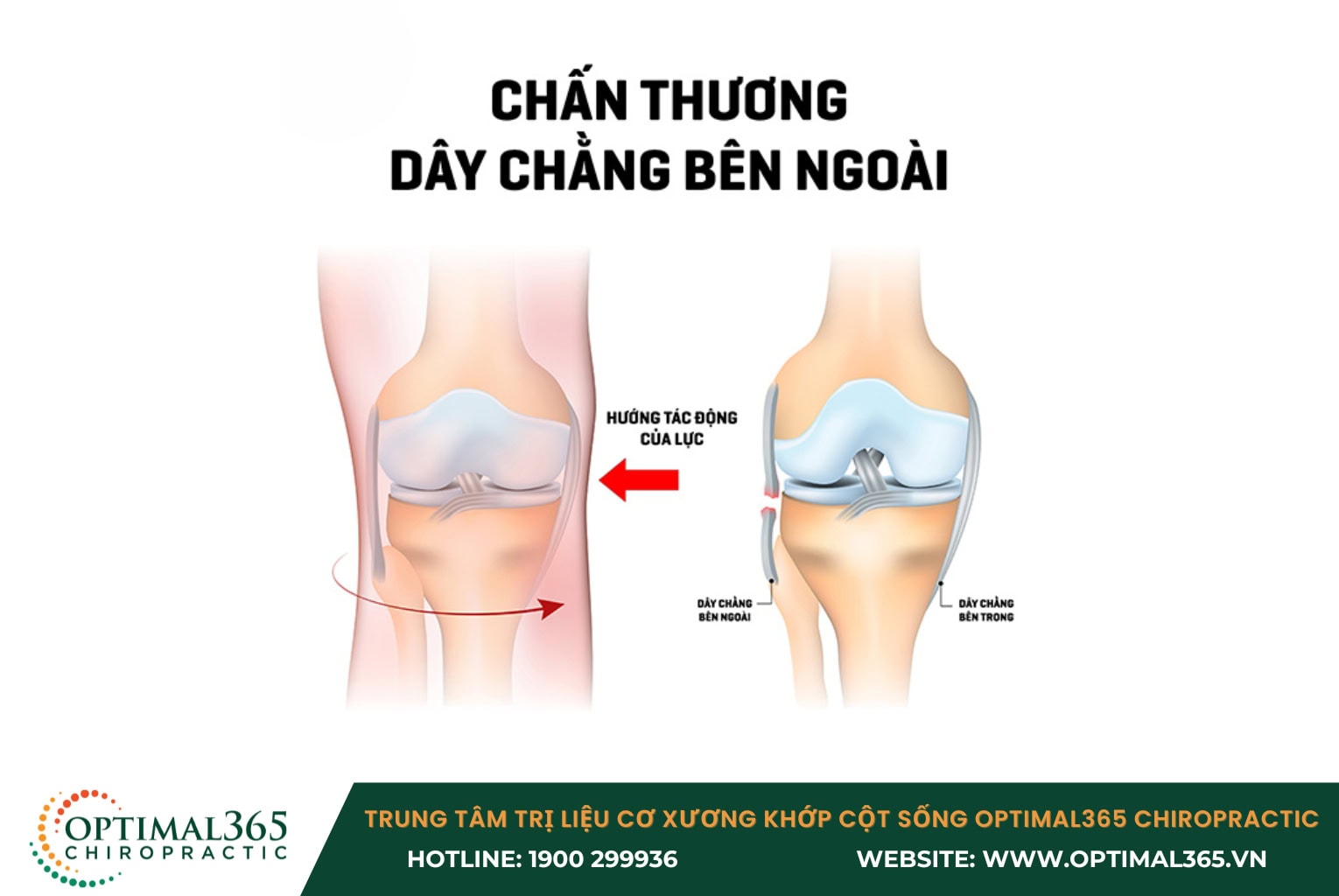  Chấn thương dây chằng MCL thường xuất hiện sau chấn thương và có thể tăng lên khi vận động