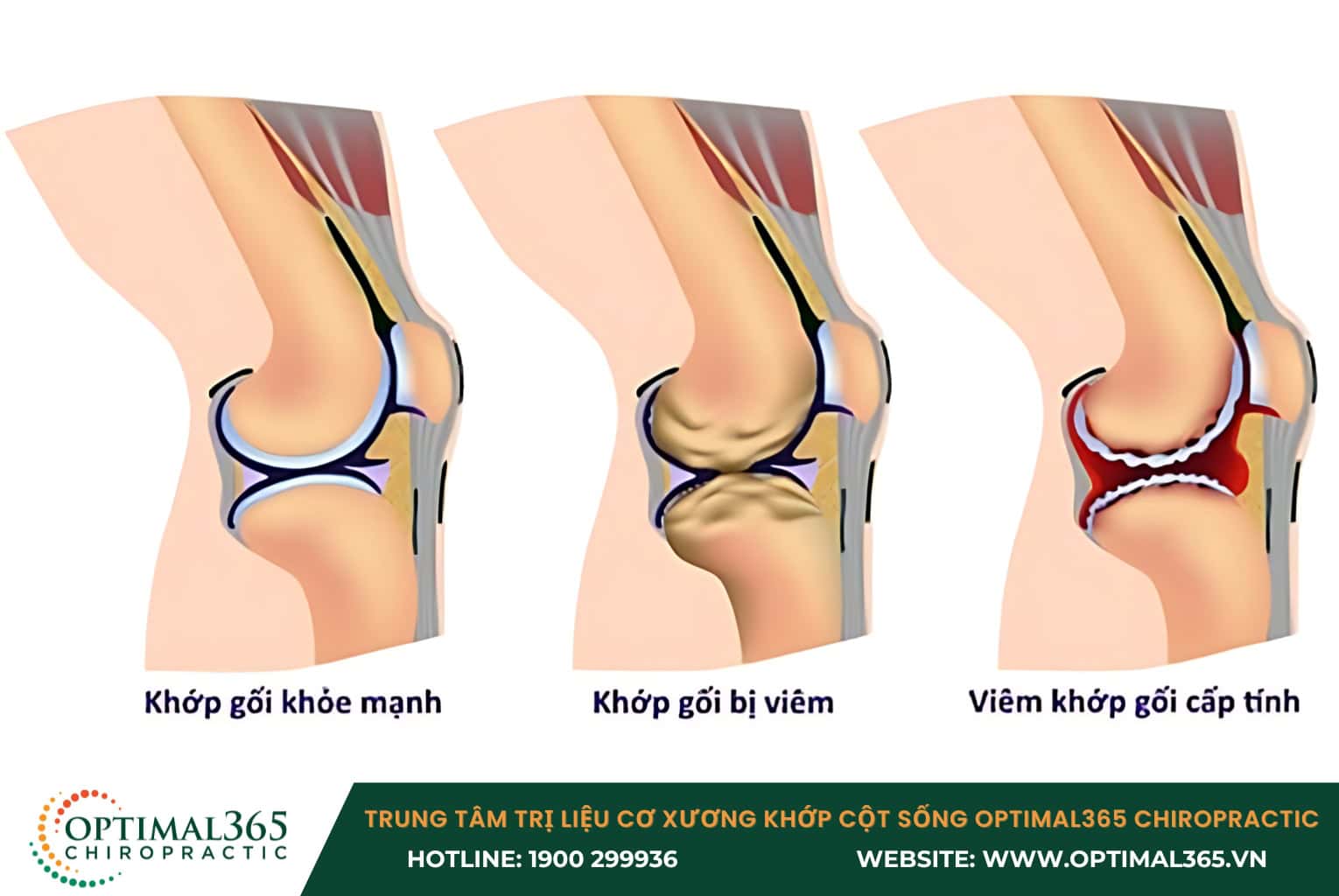Đau mãn tính ở khớp gối là biến chứng do tổn thương dây chằng và sụn chêm