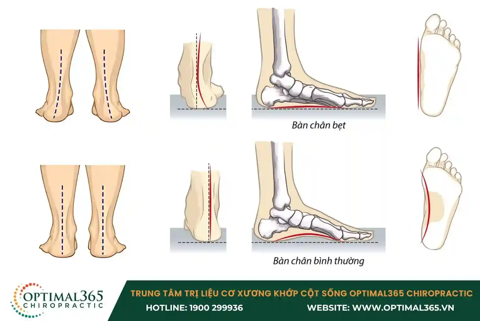 The deformation of the soles due to flat foot syndrome also affects the knee joints during movement
