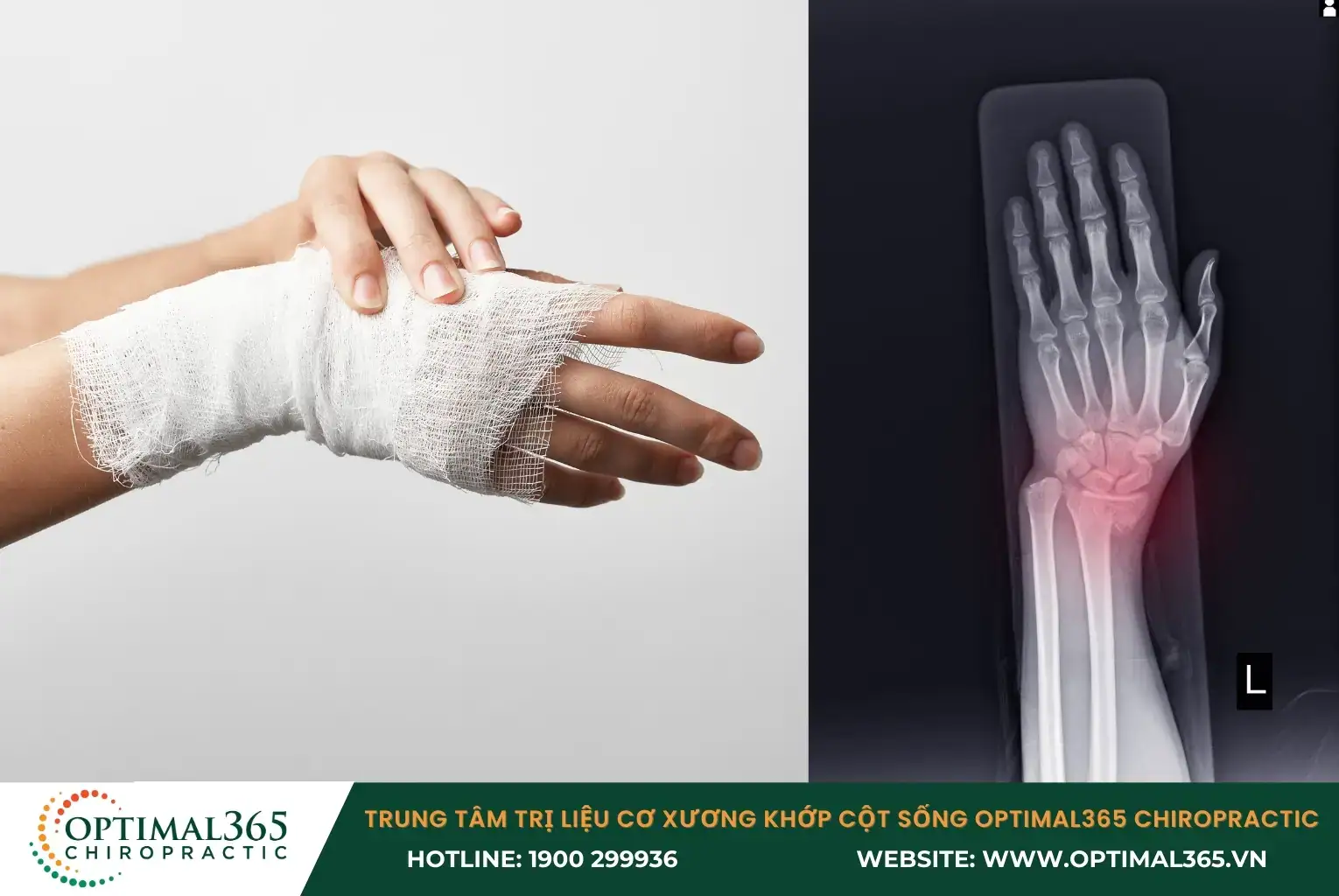 Fractures require urgent treatment.